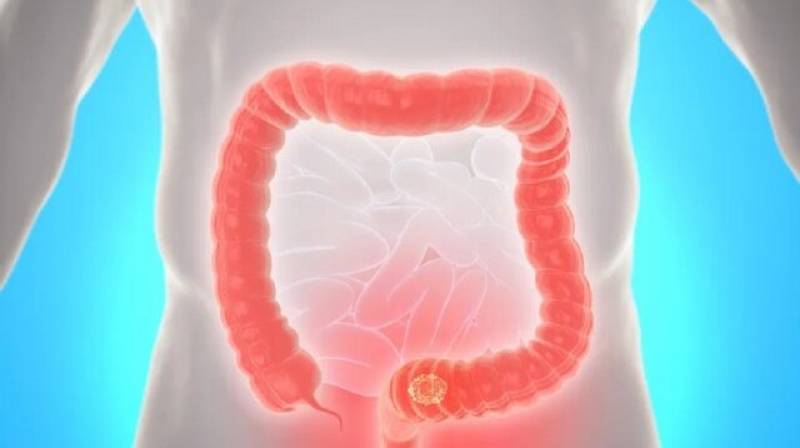 استرس مزمن و تأثیر آن بر پیشرفت سرطان روده بزرگ