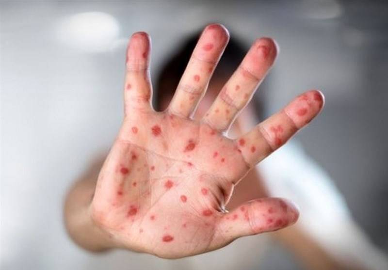 هشدار درباره بازگشت سرخک؛ خطرناک اما قابل پیشگیری