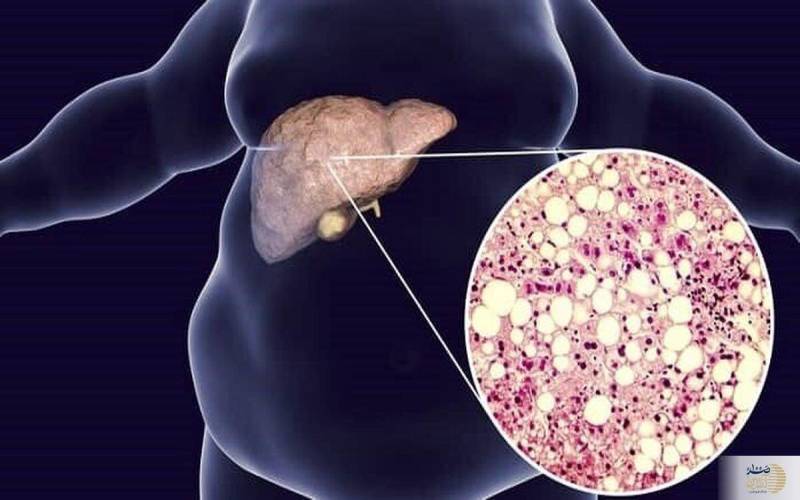 این علائم را جدی بگیرید شما یک قدم به کبد چرب نزدیک شدید